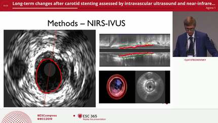 Long-term changes after carotid stenting assessed by intravascular ultrasound and near-infrared spectroscopy
