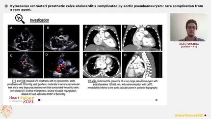 Kytococcus schroeteri prosthetic valve endocarditis complicated by aortic pseudoaneurysm: rare complication from a rare agent.