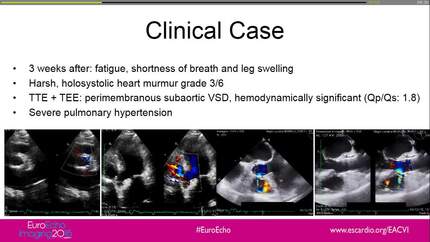 Late appearance of a ventricular septal defect after transcatheter aortic valve replacement: a rare complication