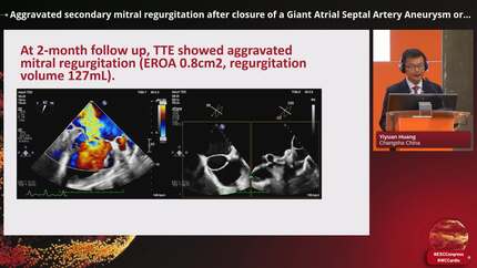 Aggravated secondary mitral regurgitation after closure of a Giant Atrial Septal Artery Aneurysm originating from the left main coronary artery.