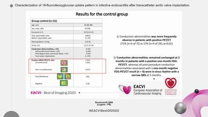 Characterization of 18-fluorodeoxyglucose uptake pattern in infective endocarditis after transcatheter aortic valve implantation.