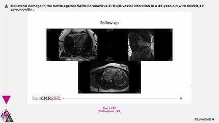 Collateral damage in the battle against SARS-Coronavirus 2: Multi-vessel infarction in a 43-year-old with COVID-19 pneumonitis
.