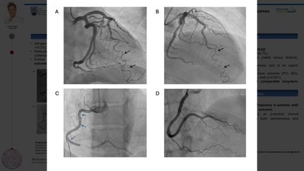 Catheter-Induced Coronary Artery Dissection in Spontaneous Coronary Artery Dissection: Incidence, Procedural Characteristics, and Outcomes