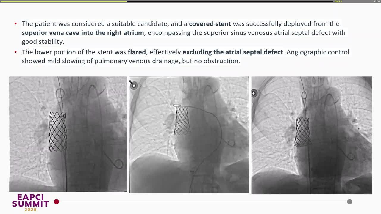 When congenital meets geriatrics: percutaneous repair of a superior sinus venosus defect with partial anomalous pulmonary venous return
