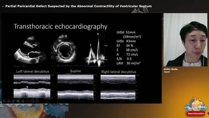 Partial Pericardial Defect Suspected by the Abnormal Contractility of Ventricular Septum
