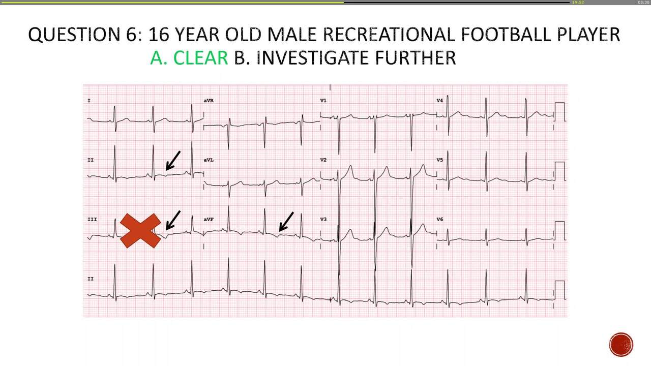 ECG in athletes quiz 