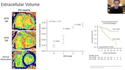 Cardiac Amyloidosis: using Imaging to Improve Recognition and Diagnosis