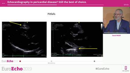 Echocardiography in pericardial disease? Still the best of choice.