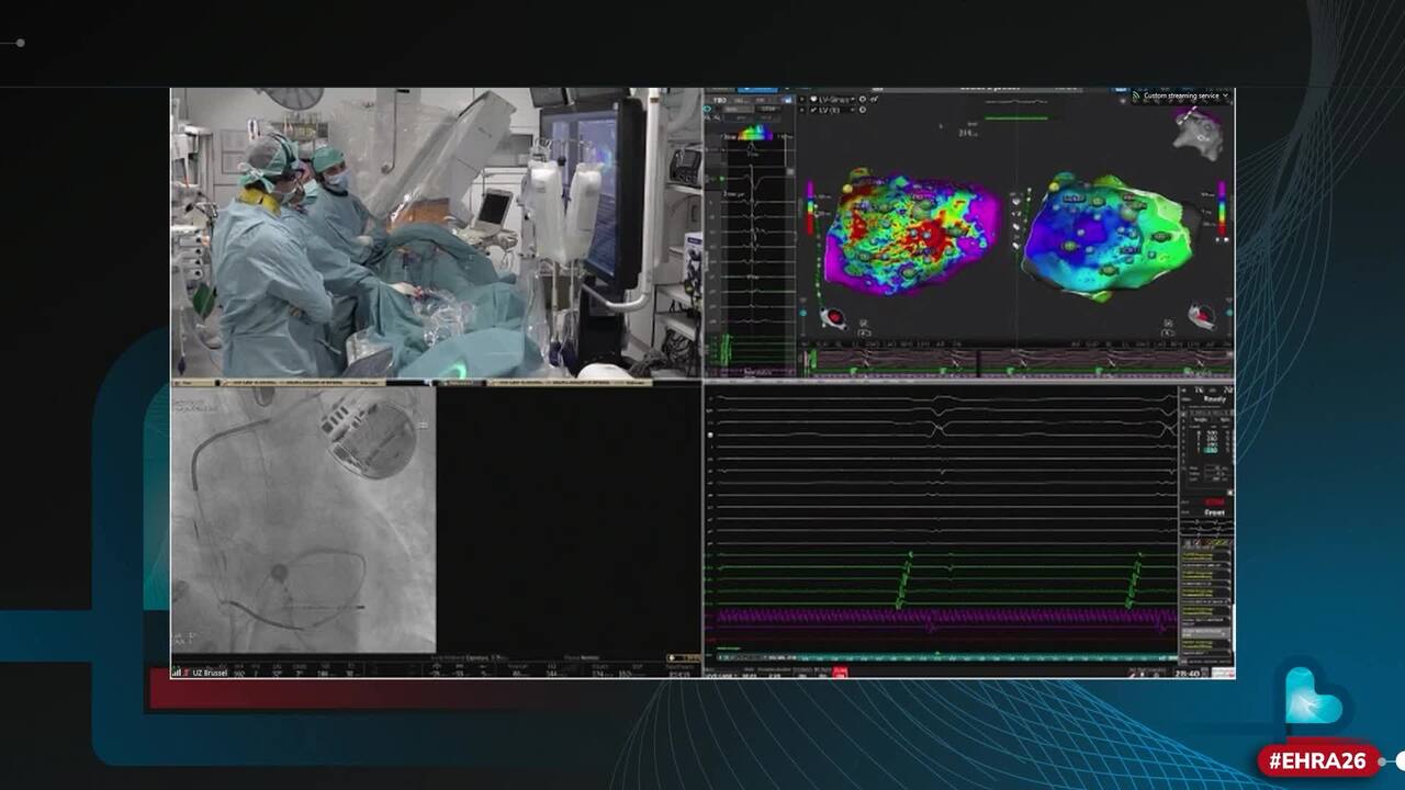 Live case: ventricle pulsed field ablation