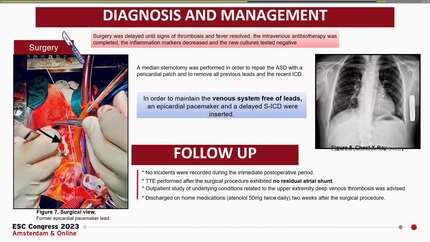 Iatrogenic atrial septal defect following percutaneous lead extraction. An unusual preventable  complication.
