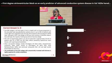 First degree atrioventricular block as an early predictor of advanced conduction system disease in Val 142Ile hereditary cardiac amiloydosis.