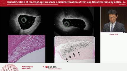 Quantification of macrophage presence and identification of thin-cap fibroatheroma by optical coherence tomography image: histopathological validation study