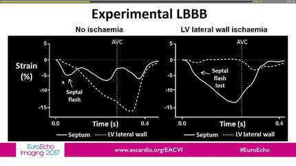 Negative crosstalk between left ventricular lateral wall and septum in left bundle branch block: "the lateral wall paradox"