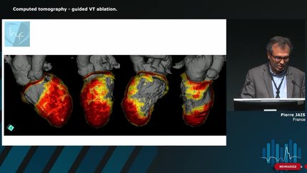 The role of imaging in ventricular tachycardia (VT) ablation