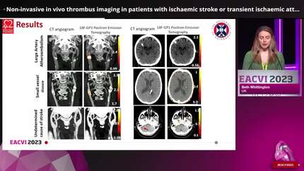 Non-invasive in vivo thrombus imaging in patients with ischaemic stroke or transient ischaemic attack