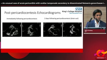 An unusual case of acute pericarditis with cardiac tamponade secondary to disseminated Neisseria gonorrhoeae infection.