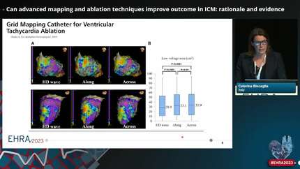 Improving outcomes in ablation of VT