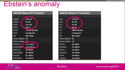 When and why to use CMR/CT to assess the RV.