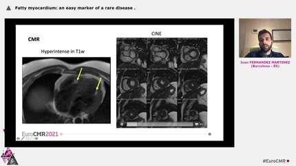 Fatty myocardium: an easy marker of a rare disease
.