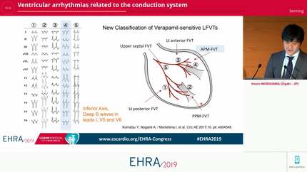 Ventricular arrhythmias related to the conduction system