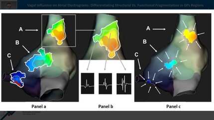 Vagal influence on atrial electrograms: differentiating structural Vs. functional fragmentation in ganglionated plexi regions