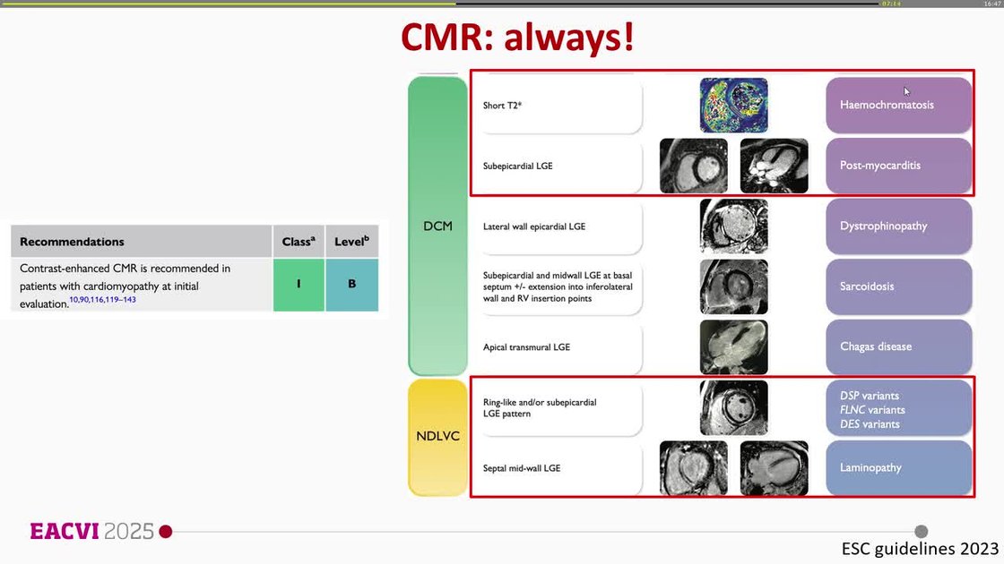 ESC 365 - When things get difficult in dilated cardiomyopathy