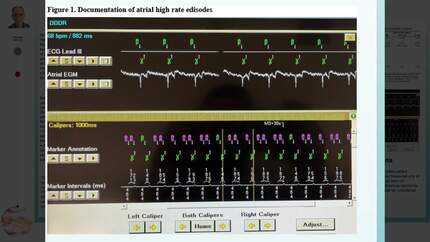 Association of growth differentiation factor 15 and soluble suppression of tumorigenicity-2 with atrial high rate episodes