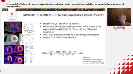 Myocardial efficiency in severe asymptomatic primary mitral regurgitation: relation to quantitative measures of regurgitation