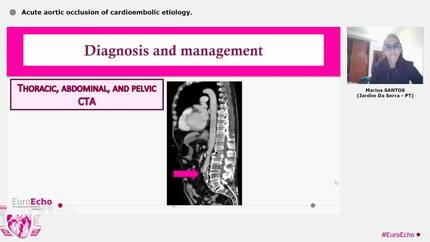 Acute aortic occlusion of cardioembolic etiology.