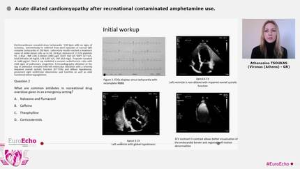 Acute dilated cardiomyopathy after recreational contaminated amphetamine use.