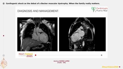 Cardiogenic shock as the debut of a Becker muscular dystrophy. When the family really matters.