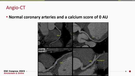 Left ventricular thrombus and multiple emboli in a young bodybuilder