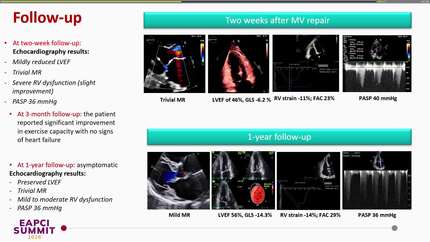 The role of right ventricle assessment in a decision-making process in patients with primary mitral regurgitation