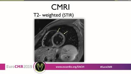 Idiopathic recurrent myopericarditis: can we keep on talking about idiopathic disease or should we look further?