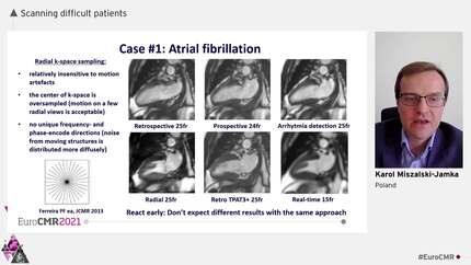 Removing artefacts in arrhythmic patients.