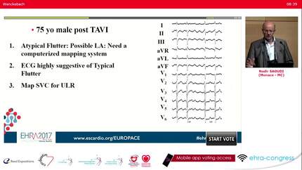 Understanding the surface ECG in atrial macro-re-entrant tachycardia.