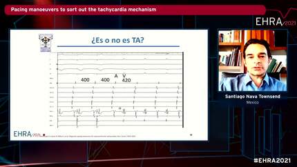 Atrioventricular nodal reentry tachycardia