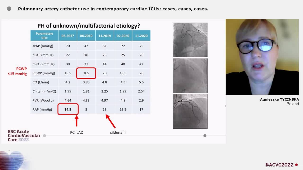 Pulmonary artery catheter use in contemporary cardiac ICUs: cases, cases, cases.