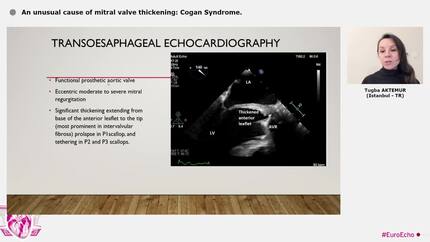 An unusual cause of mitral valve thickening: Cogan Syndrome.