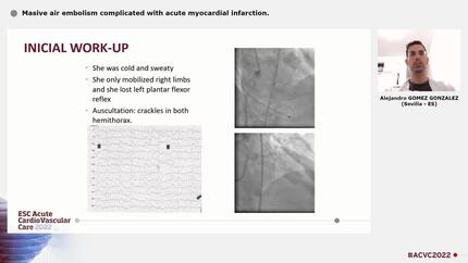 Masive air embolism complicated with acute myocardial infarction.