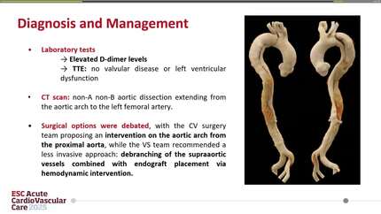 All roads lead to Rome: a hybrid approach in a non-A non-B acute aortic dissection