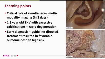 Fast TAVI valve degeneration and endocarditis unmasked by multimodality imaging, followed by surgical explantation.