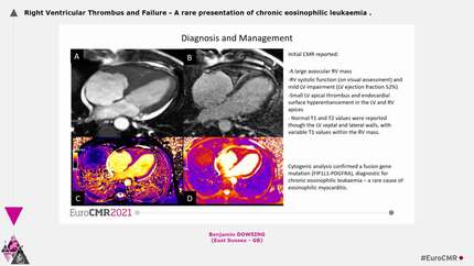 Right Ventricular Thrombus and Failure - A rare presentation of chronic eosinophilic leukaemia
.