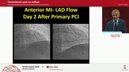 Thrombosis and no reflow