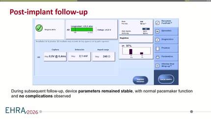 Atrial single-chamber leadless pacemaker implantation for sinus node dysfunction in a heart transplant recipient