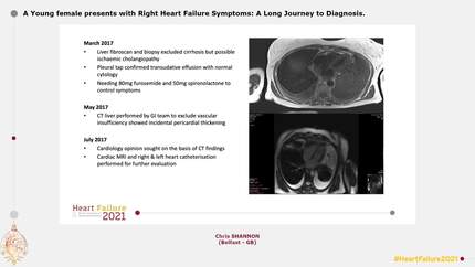 A Young female presents with Right Heart Failure Symptoms: A Long Journey to Diagnosis.