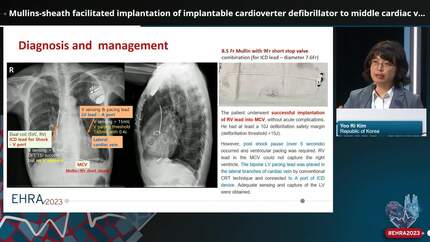 Mullins-sheath facilitated implantation of implantable cardioverter defibrillator to middle cardiac vein in a very thin patient with triple valve replacement