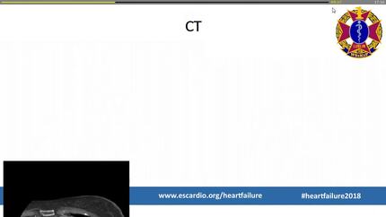 NYHA class III chronic heart failure in 76-year old female with huge coronary fistula from LCx to coronary sinus and arterial pulmonary hipertension