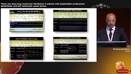 Thirty one days long ventricular fibrillation in patient with implantable cardioverter defibrillator and left ventricular assist device.