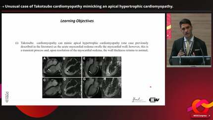 Unusual case of Takotsubo cardiomyopathy mimicking an apical hypertrophic cardiomyopathy.